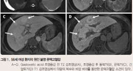 문맥동정맥 혈관질환