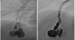 폐동정맥 기형 색전술